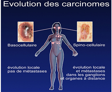 evolution-carcinomes
