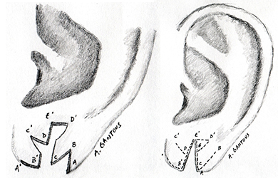 reparation-lobes-oreilles-fendues-tunisie
