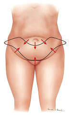 abdominoplastie a haute tension superieure tunisie