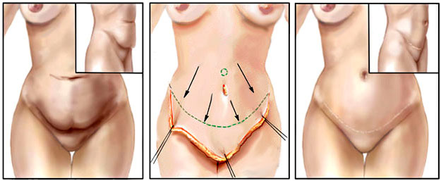 abdominoplastie tunisie