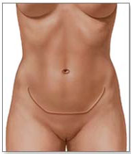 cicatrices abdominoplastie tunisie