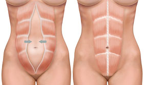 diastasis abdominoplastie tunisie