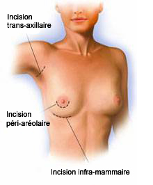 cicatrices augmentation mammaire tunisie