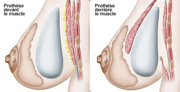 position implant mammaire tunisie