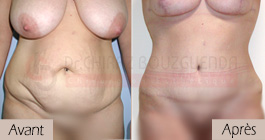 photos-avant-apres-patient1-chirurgie-esthetique-ventre-tunisie