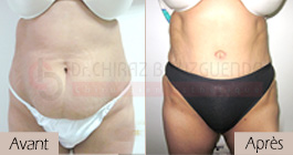 photos-avant-apres-patient5-chirurgie-esthetique-ventre-tunisie