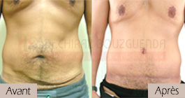 photos-avant-apres-patient6-chirurgie-esthetique-ventre-tunisie