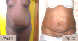 photos-avant-apres-patient9-chirurgie-esthetique-ventre-tunisie
