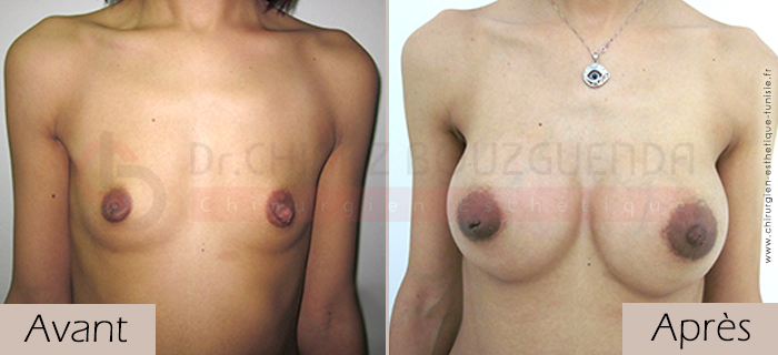 photos-avant-apres-patiente3-augmentation-mammaire-par-protheses-en-tunisie