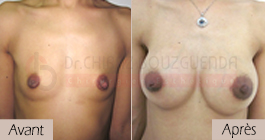 photos-avant-apres-patiente3-augmentation-mammaire-par-protheses-en-tunisie