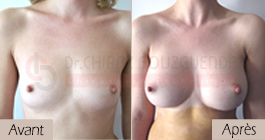 photos-avant-apres-patiente5-augmentation-mammaire-par-protheses-en-tunisie
