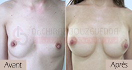 photos-avant-apres-patiente6-augmentation-mammaire-par-protheses-en-tunisie