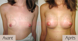 photos-avant-apres-patiente7-augmentation-mammaire-par-protheses-en-tunisie