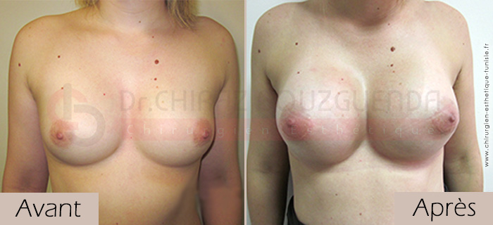 photos-avant-apres-patiente1-changement-protheses-mammaires-Tunisie