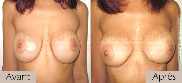 photos-avant-apres-patiente3-changement-protheses-mammaires-Tunisie