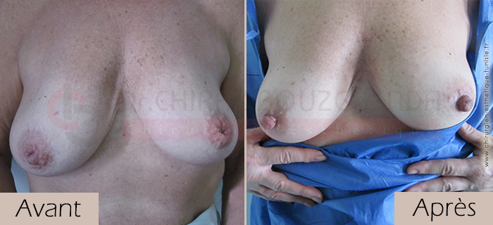photos-avant-apres-patiente1-mamelons-ombiliques-tunisie