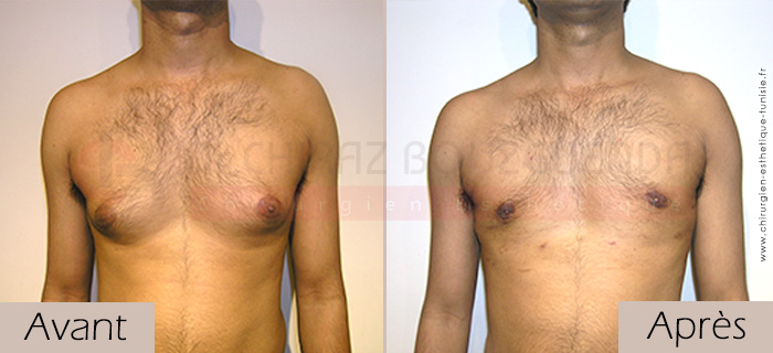 photos-avant-apres-patient1-reduction-mammaire-masculine-tunisie