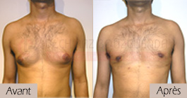 photos-avant-apres-patient1-reduction-mammaire-masculine-tunisie