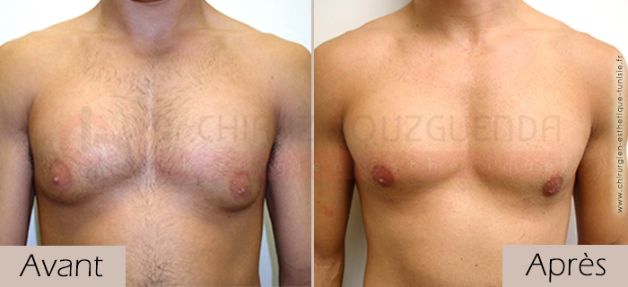 photos-avant-apres-patient2-reduction-mammaire-masculine-tunisie