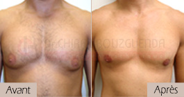 photos-avant-apres-patient2-reduction-mammaire-masculine-tunisie