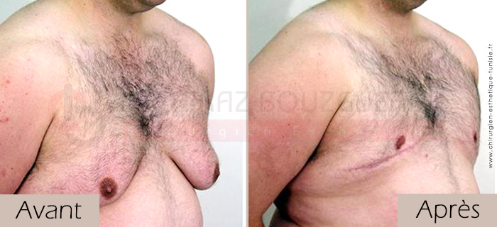 photos-avant-apres-patient3-reduction-mammaire-masculine-tunisie