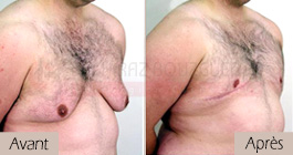 photos-avant-apres-patient3-reduction-mammaire-masculine-tunisie