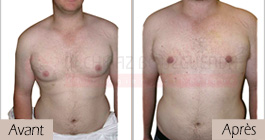 photos-avant-apres-patient4-reduction-mammaire-masculine-tunisie