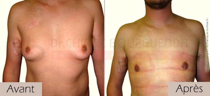 photos-avant-apres-patient5-reduction-mammaire-masculine-tunisie