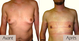 photos-avant-apres-patient5-reduction-mammaire-masculine-tunisie