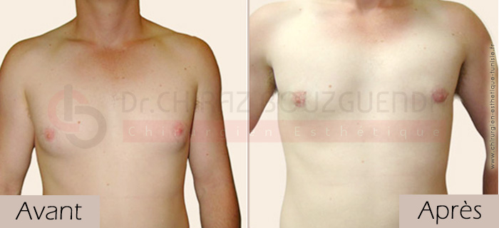 photos-avant-apres-patient6-reduction-mammaire-masculine-tunisie