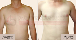 photos-avant-apres-patient6-reduction-mammaire-masculine-tunisie