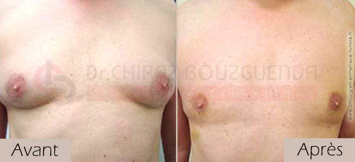 photos-avant-apres-patient7-reduction-mammaire-masculine-tunisie