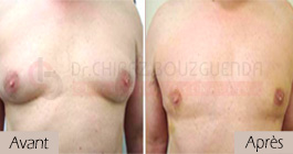 photos-avant-apres-patient7-reduction-mammaire-masculine-tunisie