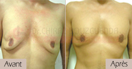 photos-avant-apres-patient8-reduction-mammaire-masculine-tunisie