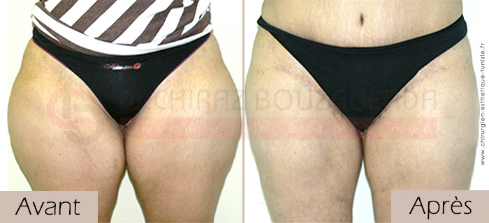 photos-avant-apres-patient1-chirurgie-lifting-cuisses-tunisie