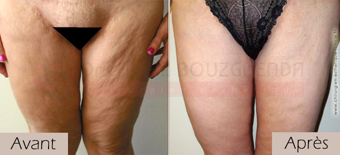 photos-avant-apres-patient2-chirurgie-lifting-cuisses-tunisie