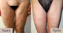 photos-avant-apres-patient2-chirurgie-lifting-cuisses-tunisie