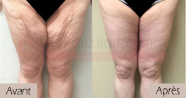 photos-avant-apres-patient3-chirurgie-lifting-cuisses-tunisie