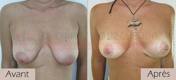 photos-avant-apres-patiente1-lifting-mammaire-tunisie