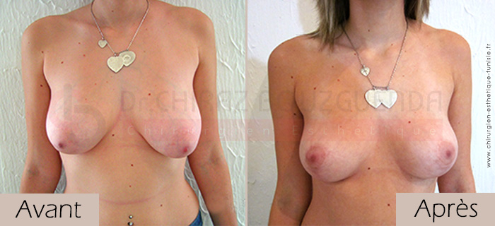 photos-avant-apres-patiente2-lifting-mammaire-tunisie