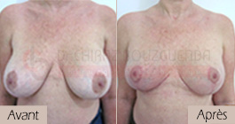 photos-avant-apres-patiente3-lifting-mammaire-tunisie