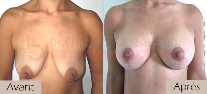 photos-avant-apres-patiente4-lifting-mammaire-tunisie
