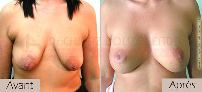 photos-avant-apres-patiente5-lifting-mammaire-tunisie
