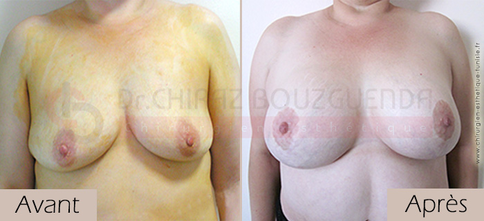 photos-avant-apres-patiente6-lifting-mammaire-tunisie