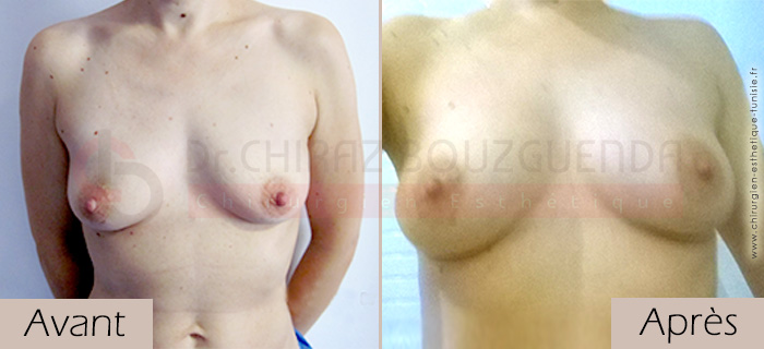 photos-avant-apres-patiente2-augmentation-mammaire-par-lipofilling-tunisie