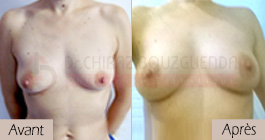 photos-avant-apres-patiente2-augmentation-mammaire-par-lipofilling-tunisie