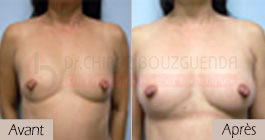 photos-avant-apres-patiente3-augmentation-mammaire-par-lipofilling-tunisie