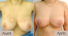 photos-avant-apres-patient1-reduction-seins-en-tunisie