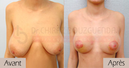 photos-avant-apres-patient2-reduction-seins-en-tunisie