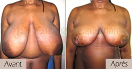 photos-avant-apres-patient3-reduction-seins-en-tunisie